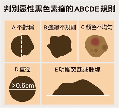 腹部長痣|是痣還是瘤？黑色素瘤的類型、症狀與治療